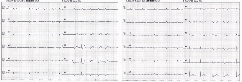 は af と Atrial Fibrillation