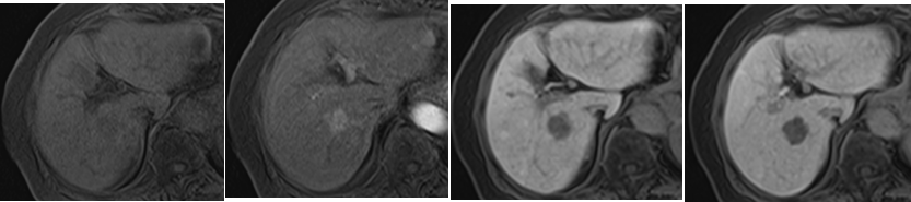 造影MRI