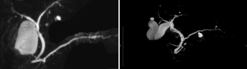 MRCP/normal, abnormal