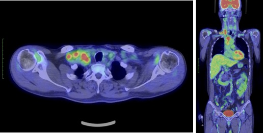 PET-CT