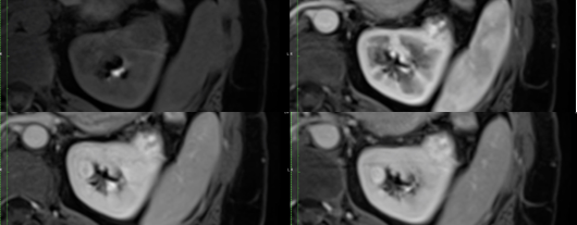 造影MRI